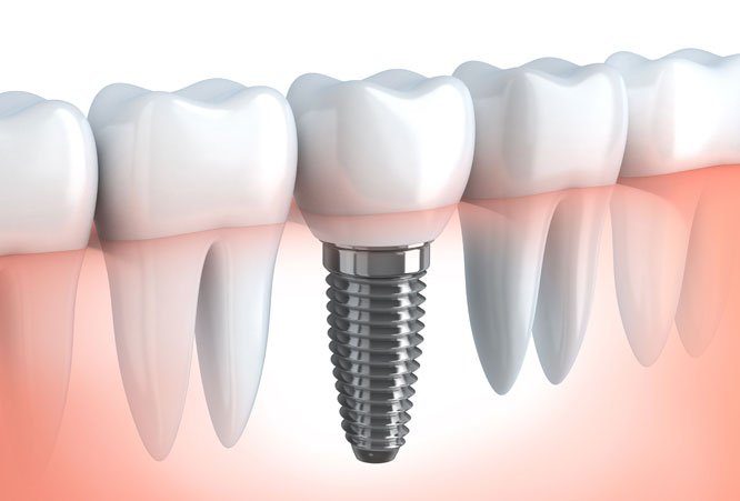 6.人工歯の接続