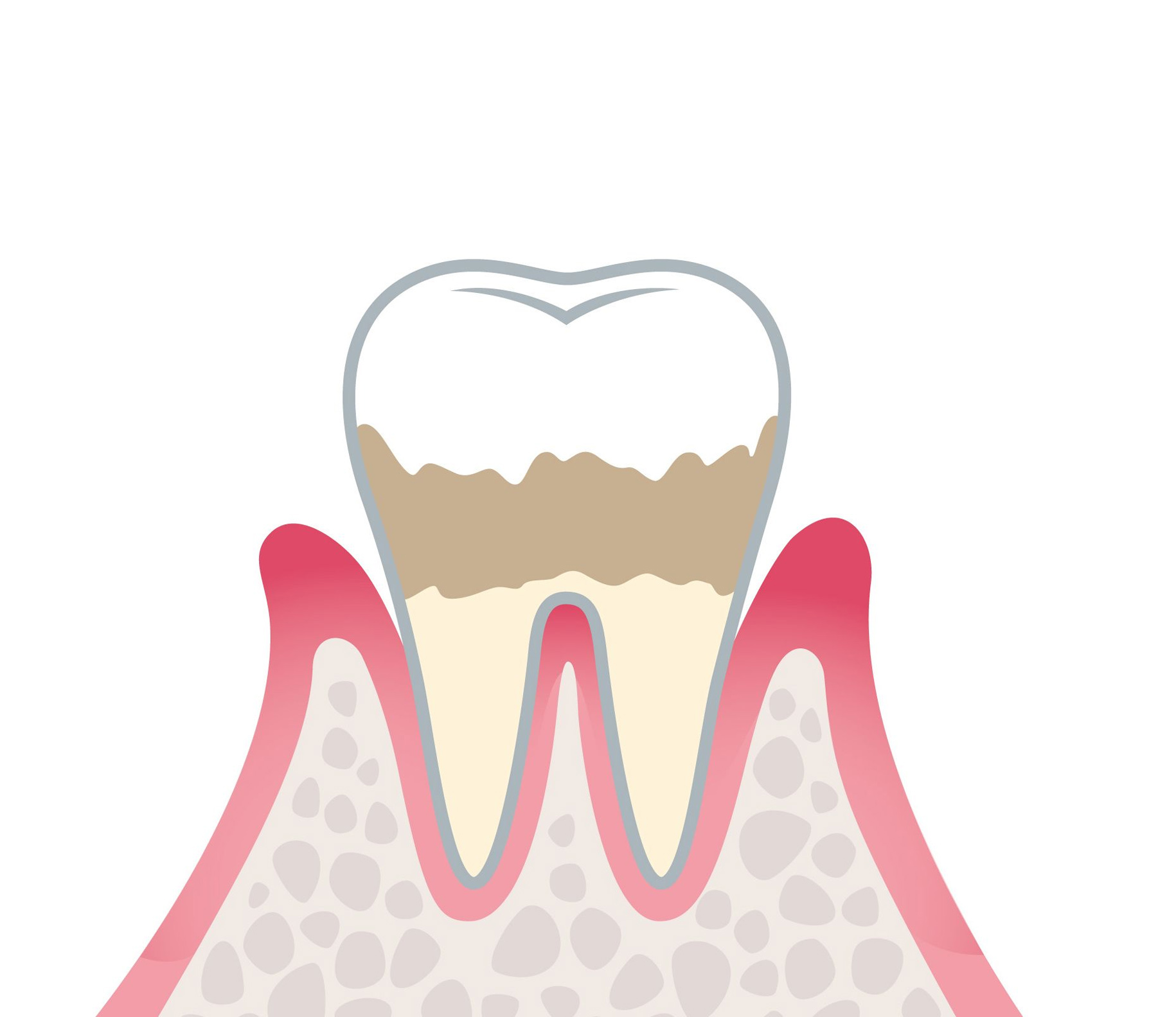 歯周炎（軽度）