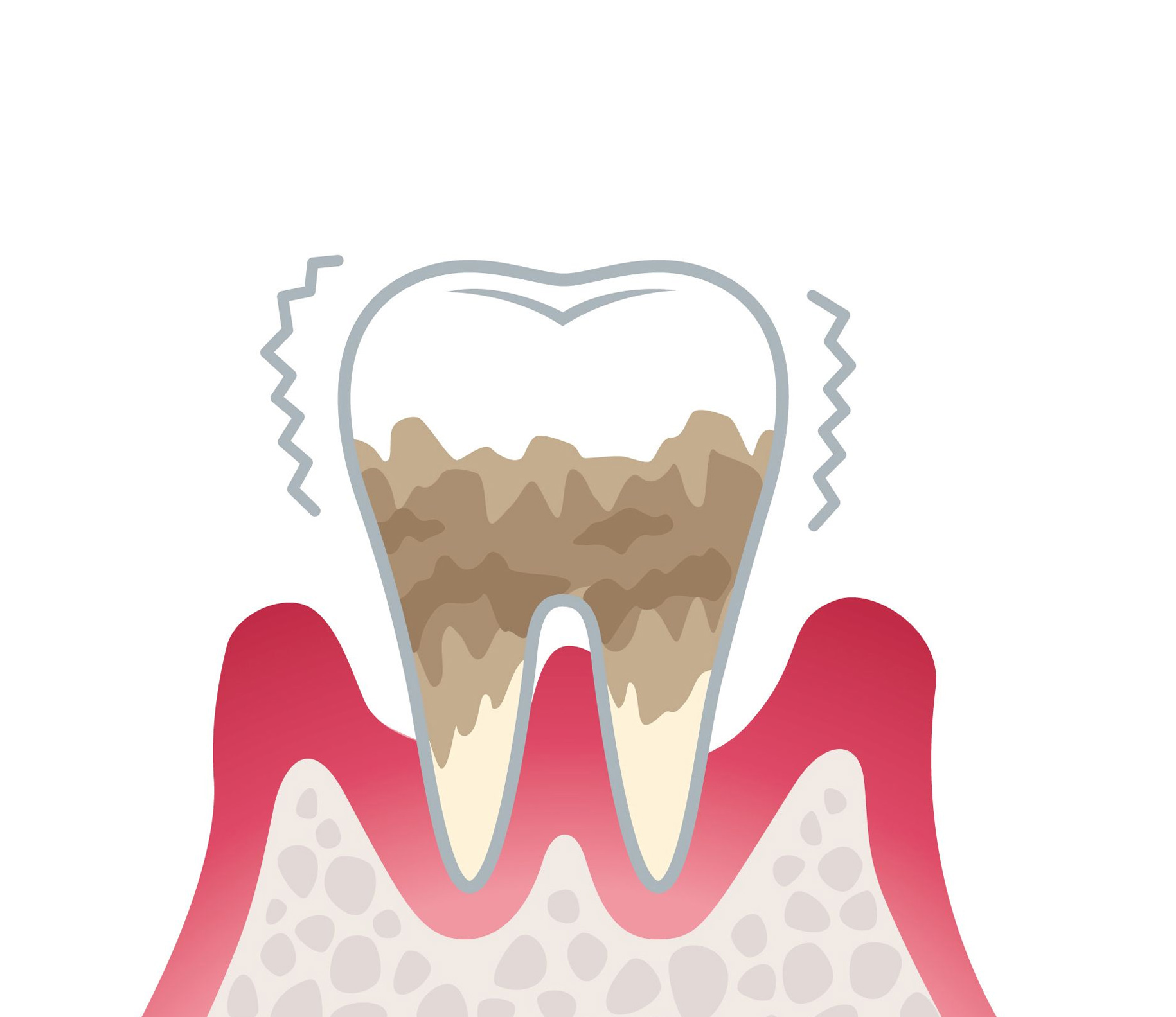 歯周炎（重度）